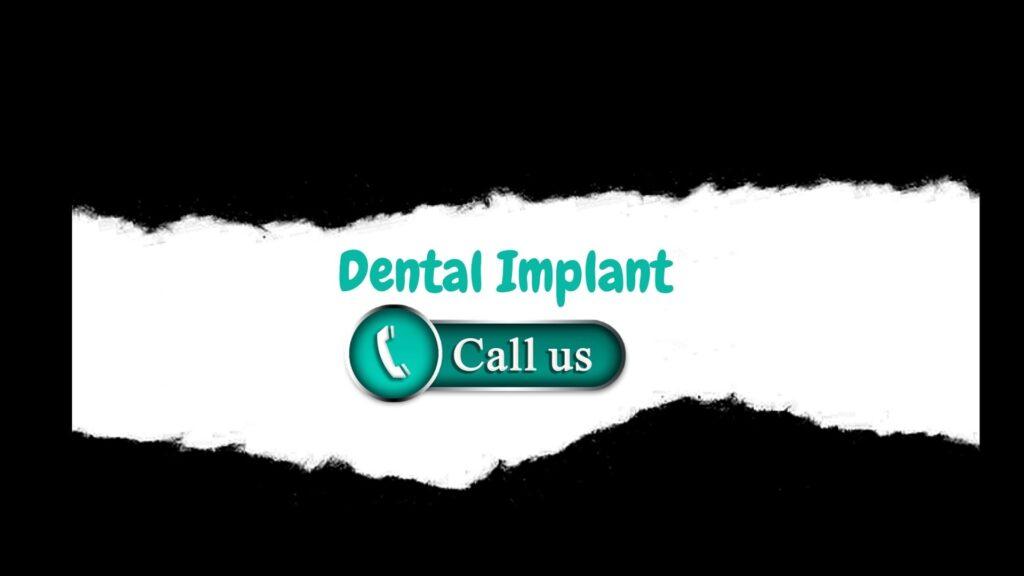 dental Implant