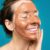 Skin Care for People with Rosacea
