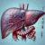 Comprehensive Liver Blood Test Now Offered in Tewkesbury